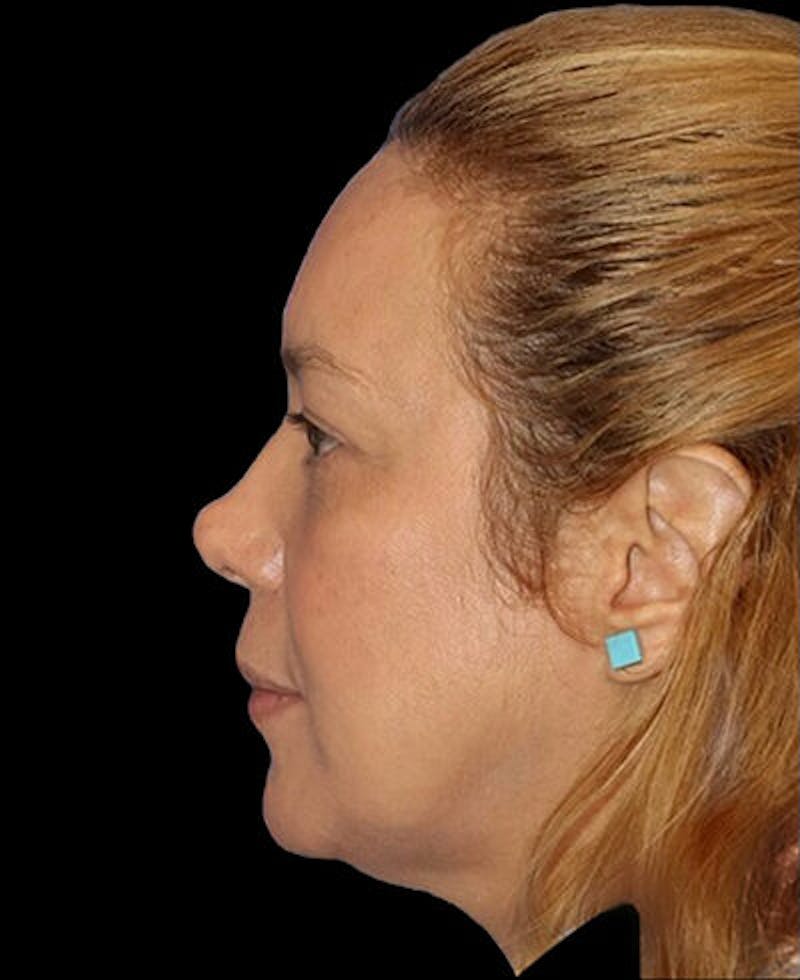 Blepharoplasty (Eyelid Surgery) Before & After Gallery - Patient 290089 - Image 6