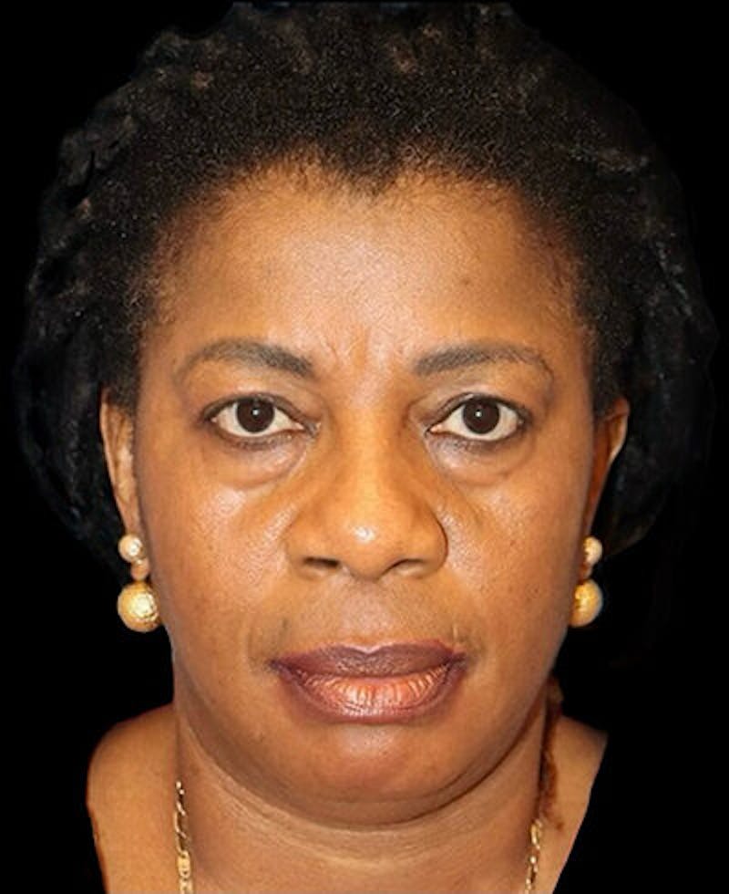 Blepharoplasty (Eyelid Surgery) Before & After Gallery - Patient 358772 - Image 1