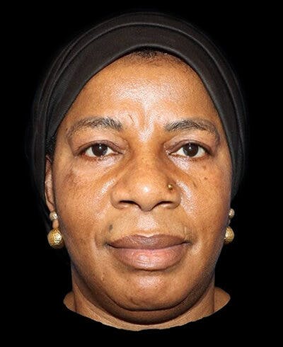 Blepharoplasty (Eyelid Surgery) Before & After Gallery - Patient 358772 - Image 2