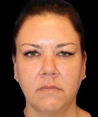 Blepharoplasty (Eyelid Surgery) Before & After Gallery - Patient 289909 - Image 1