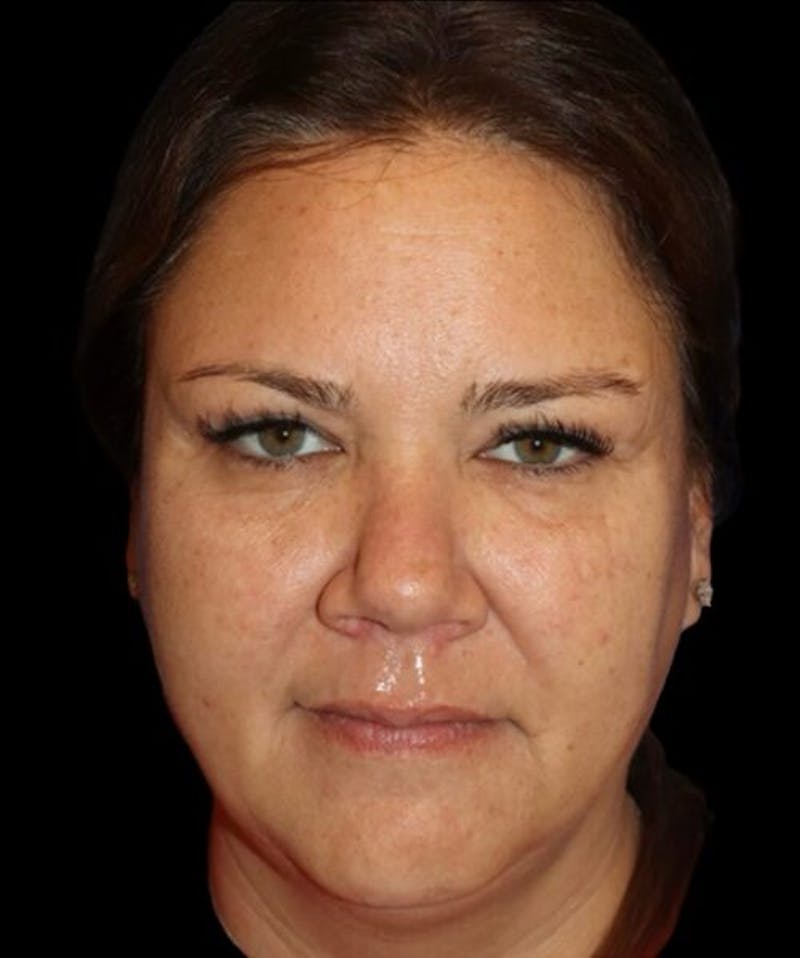 Blepharoplasty (Eyelid Surgery) Before & After Gallery - Patient 289909 - Image 2