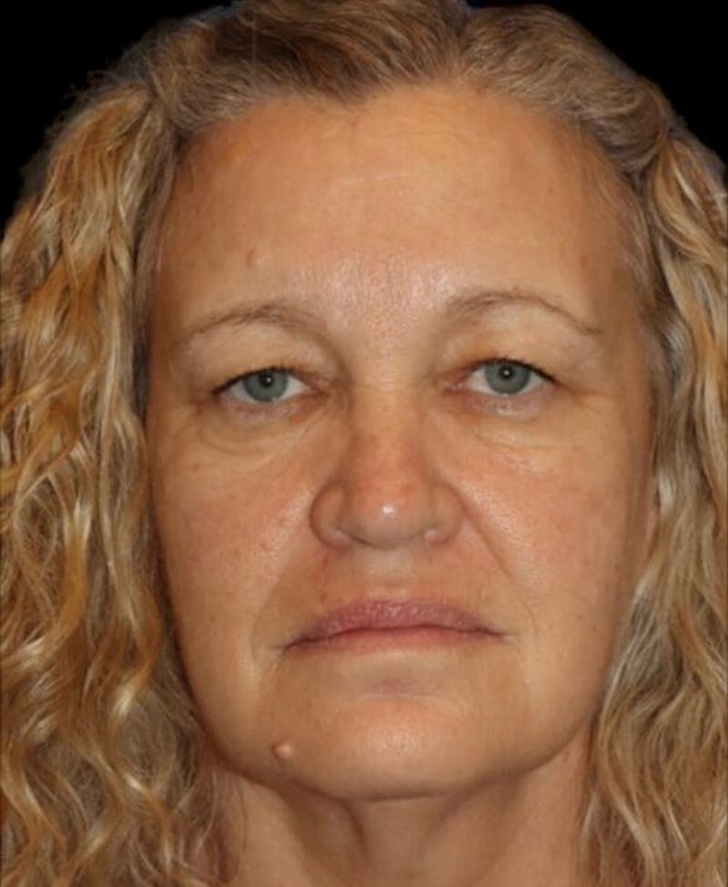 Blepharoplasty (Eyelid Surgery) Before & After Gallery - Patient 406320 - Image 1