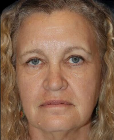 Blepharoplasty (Eyelid Surgery) Before & After Gallery - Patient 406320 - Image 2