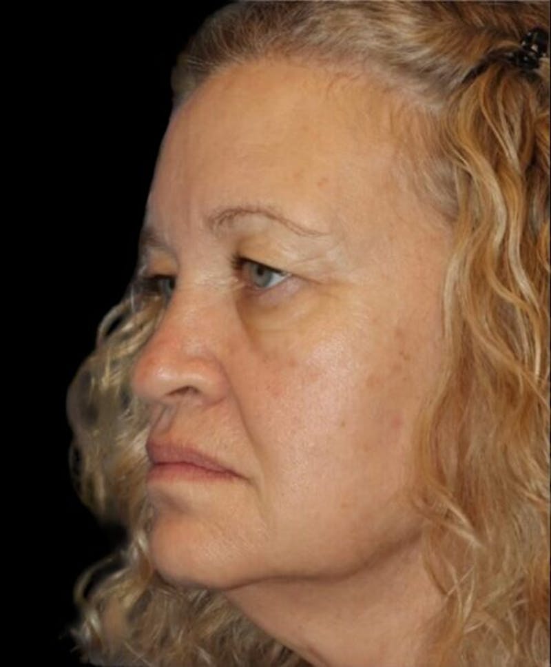 Blepharoplasty (Eyelid Surgery) Before & After Gallery - Patient 406320 - Image 3