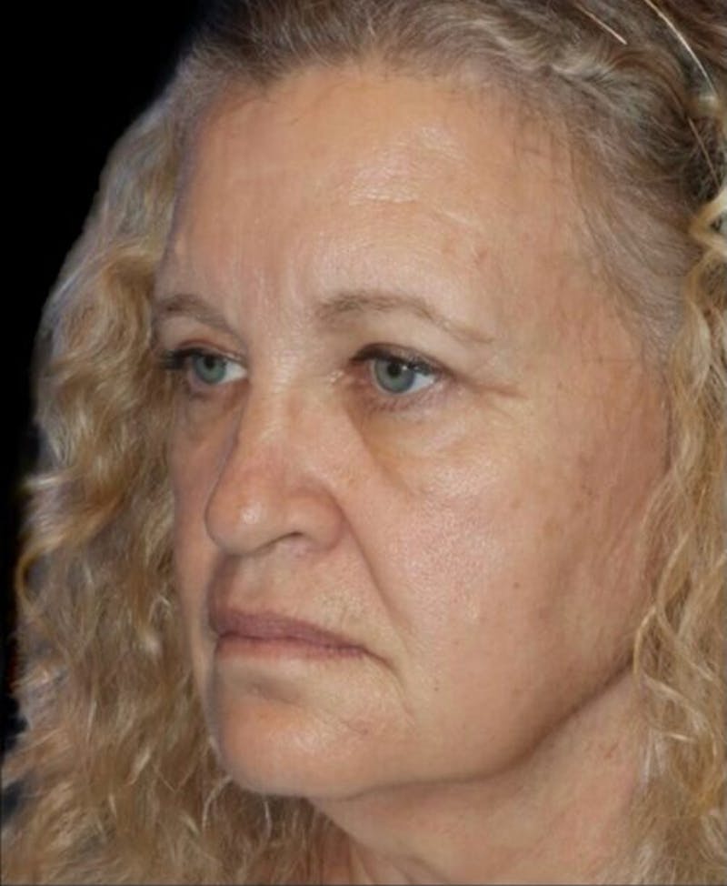 Blepharoplasty (Eyelid Surgery) Before & After Gallery - Patient 406320 - Image 4