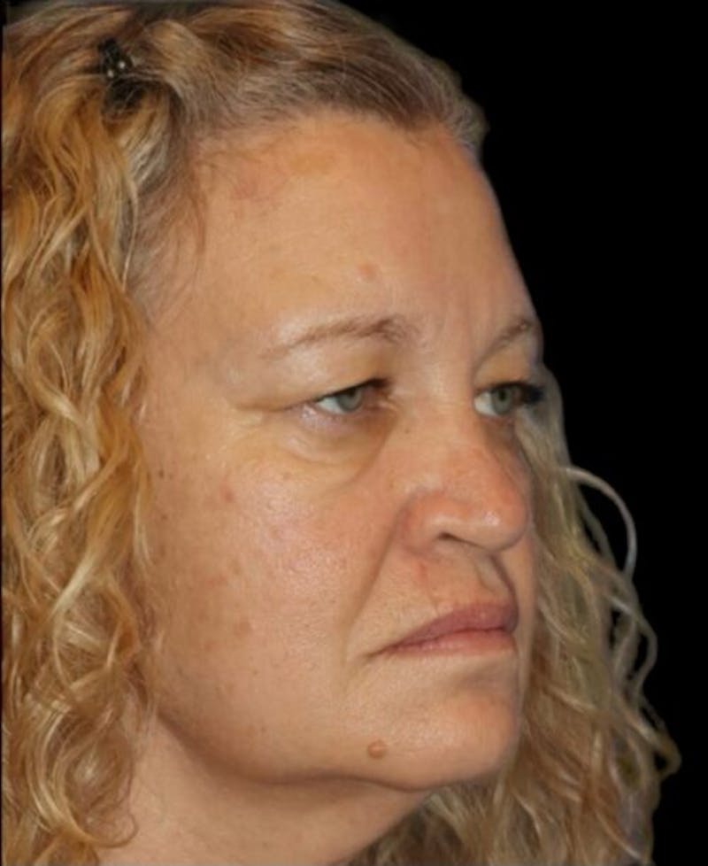 Blepharoplasty (Eyelid Surgery) Before & After Gallery - Patient 406320 - Image 5