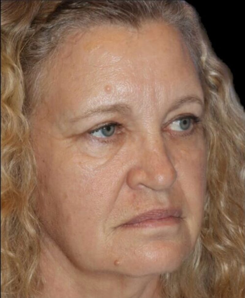Blepharoplasty (Eyelid Surgery) Before & After Gallery - Patient 406320 - Image 6