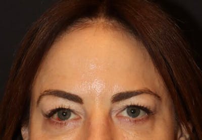Blepharoplasty (Eyelid Surgery) Before & After Gallery - Patient 154755 - Image 1