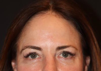 Blepharoplasty (Eyelid Surgery) Before & After Gallery - Patient 154755 - Image 2
