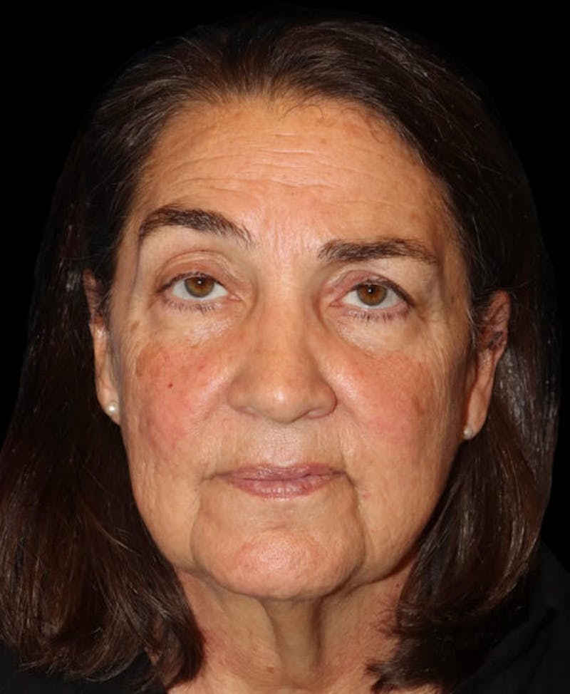 Facelift Before & After Gallery - Patient 224190 - Image 1
