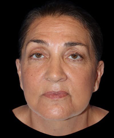 Facelift Before & After Gallery - Patient 224190 - Image 2