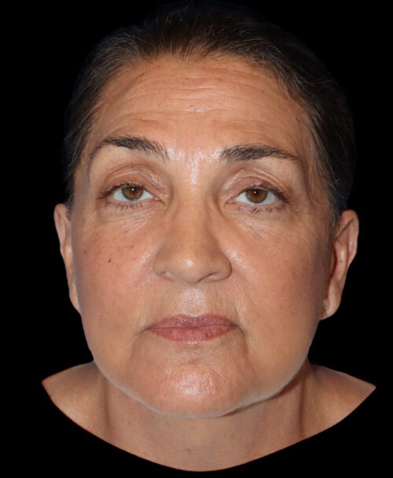 Facelift Before & After Gallery - Patient 224190 - Image 2