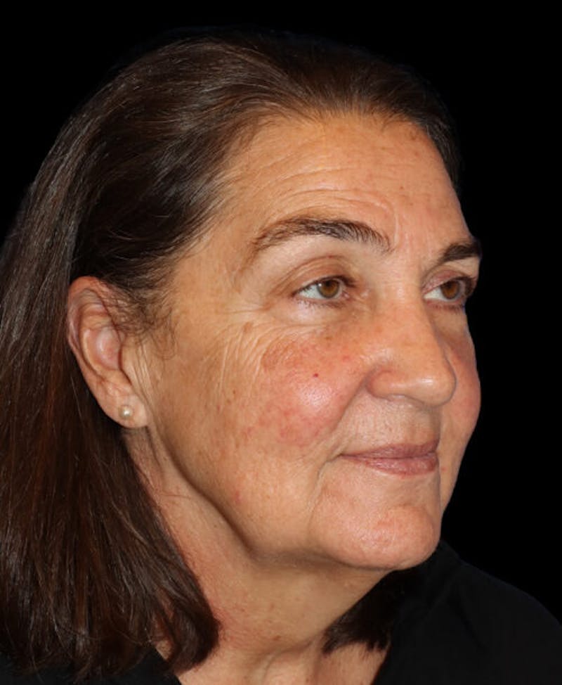 Facelift Before & After Gallery - Patient 224190 - Image 3