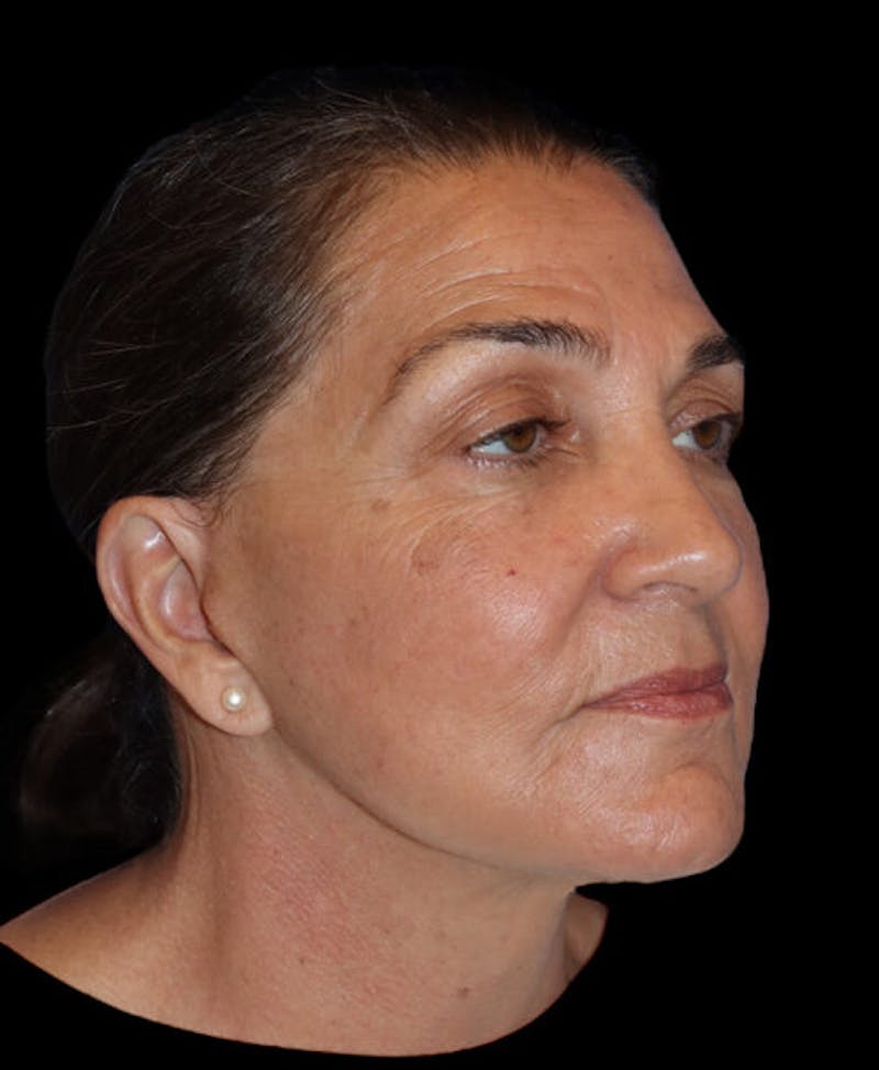 Facelift Before & After Gallery - Patient 224190 - Image 4