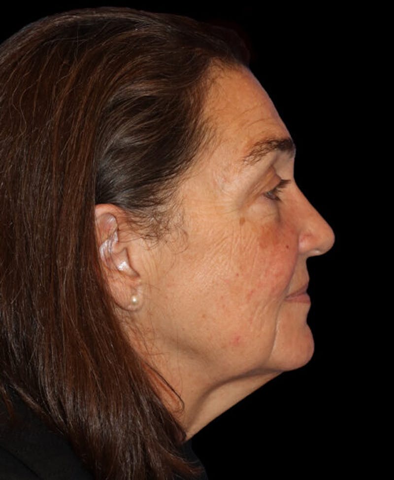 Facelift Before & After Gallery - Patient 224190 - Image 5
