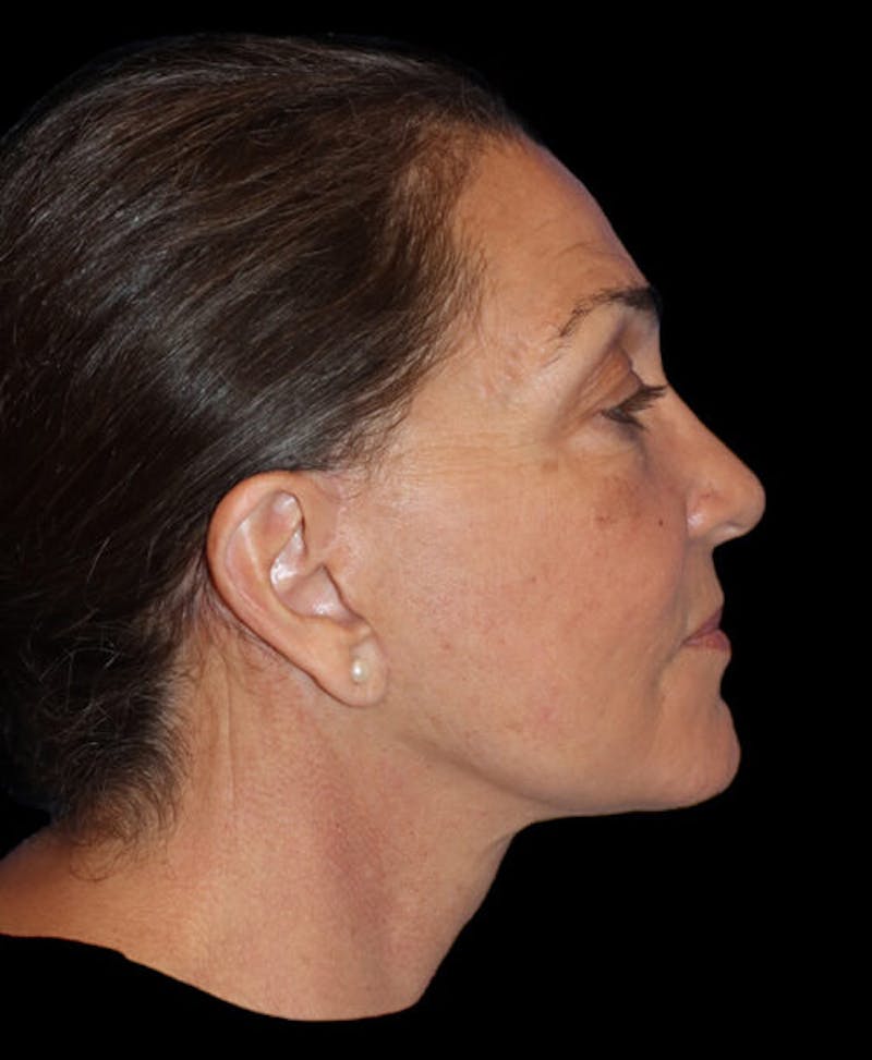 Facelift Before & After Gallery - Patient 224190 - Image 6