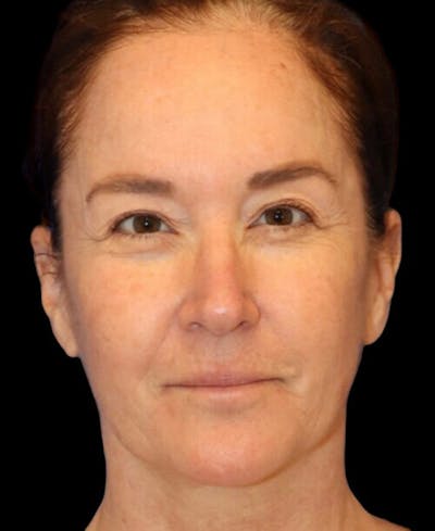 Facelift Before & After Gallery - Patient 400804 - Image 1