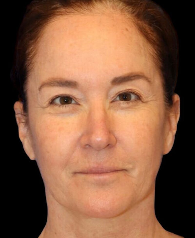 Facelift Before & After Gallery - Patient 400804 - Image 1
