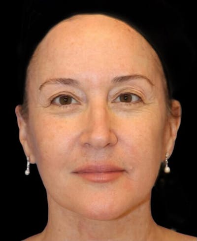 Facelift Before & After Gallery - Patient 400804 - Image 2