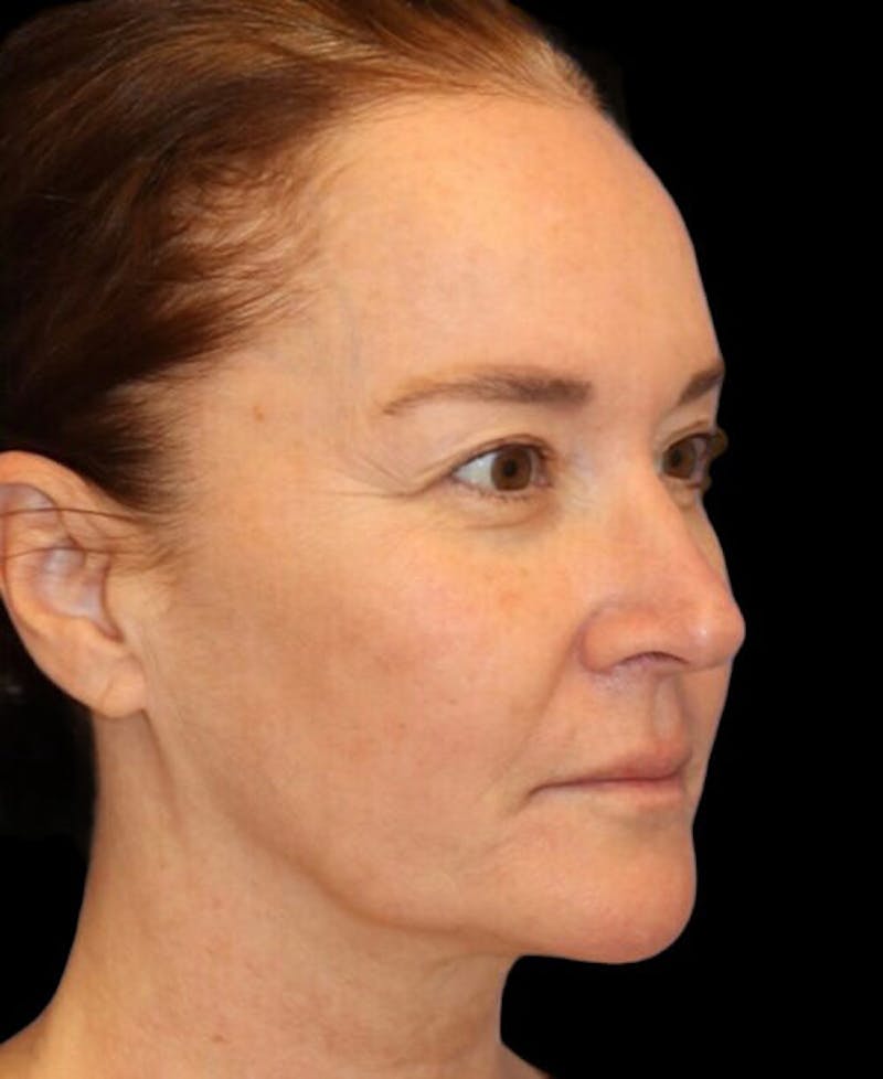 Facelift Before & After Gallery - Patient 400804 - Image 3