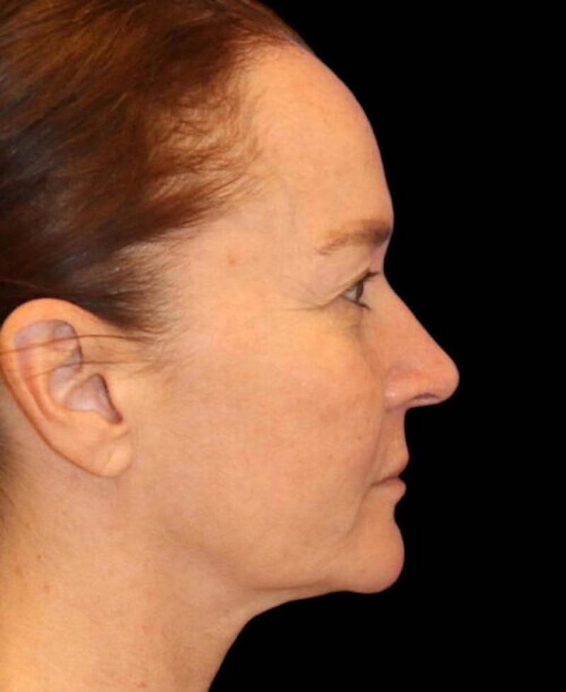 Facelift Before & After Gallery - Patient 400804 - Image 5