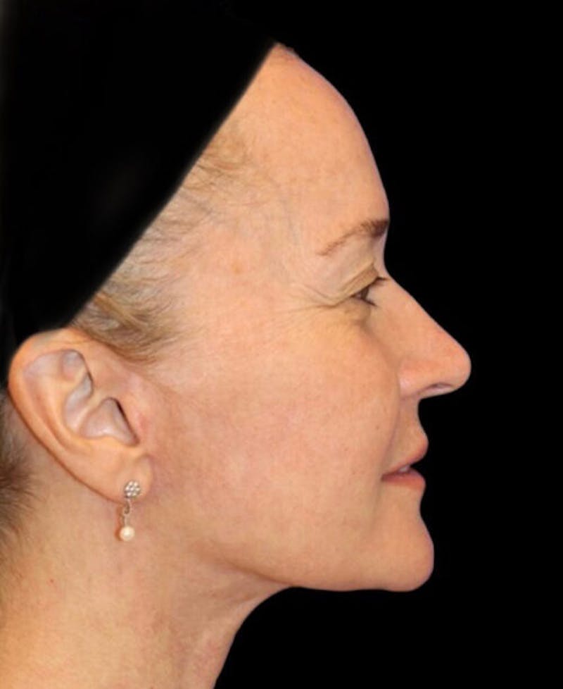 Facelift Before & After Gallery - Patient 400804 - Image 6