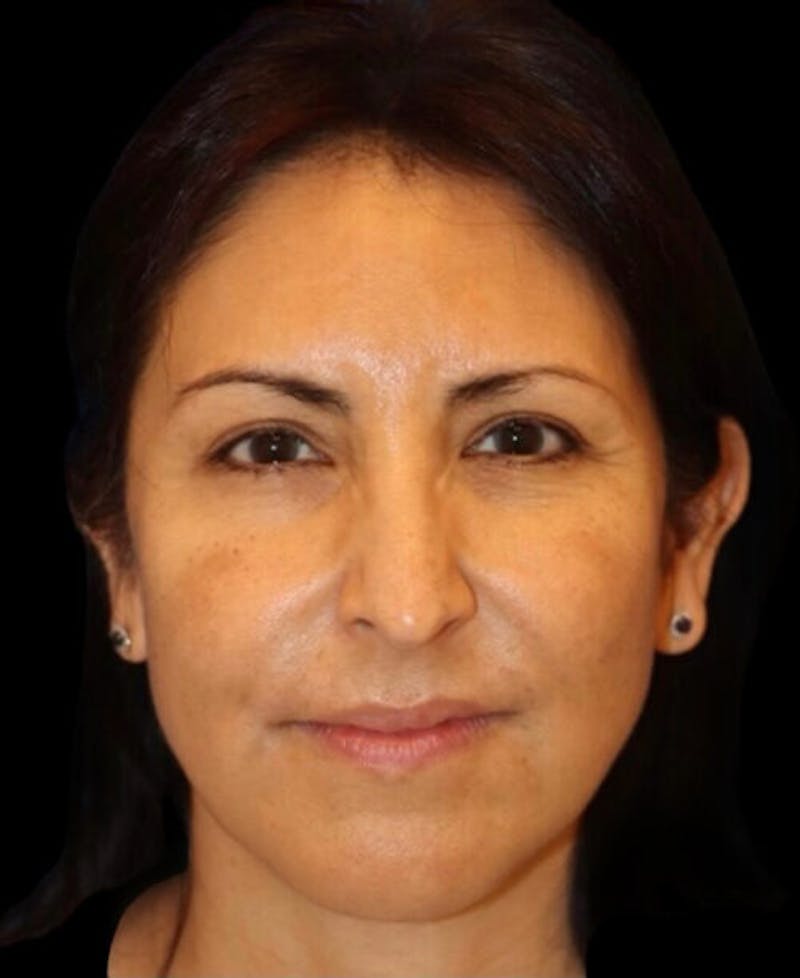 Facelift Before & After Gallery - Patient 336081 - Image 1