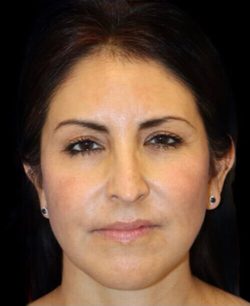 Facelift Before & After Gallery - Patient 336081 - Image 2