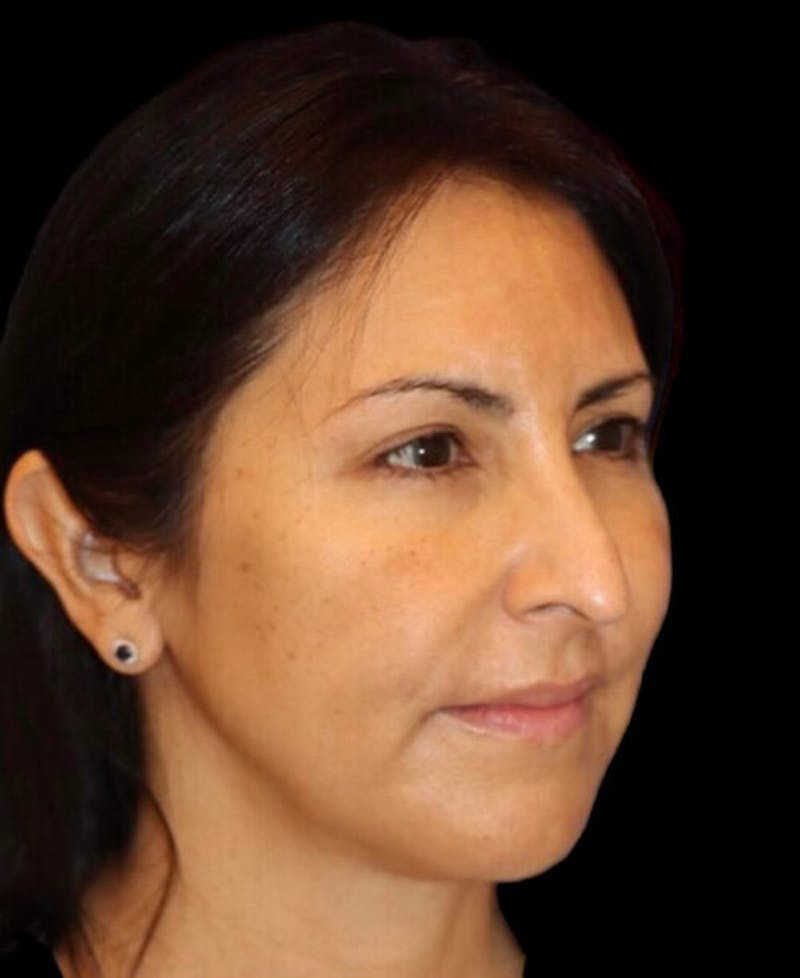 Facelift Before & After Gallery - Patient 336081 - Image 3