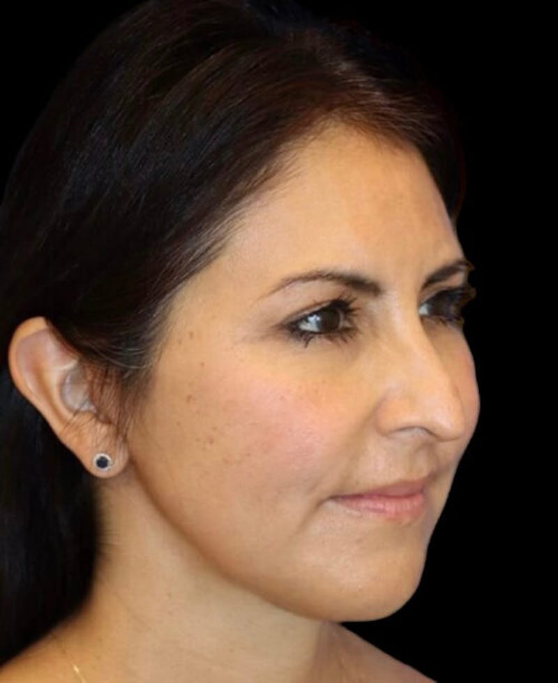 Facelift Before & After Gallery - Patient 336081 - Image 4