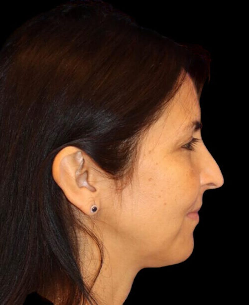 Facelift Before & After Gallery - Patient 336081 - Image 5