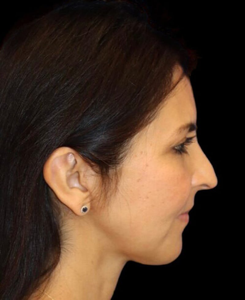 Facelift Before & After Gallery - Patient 336081 - Image 6