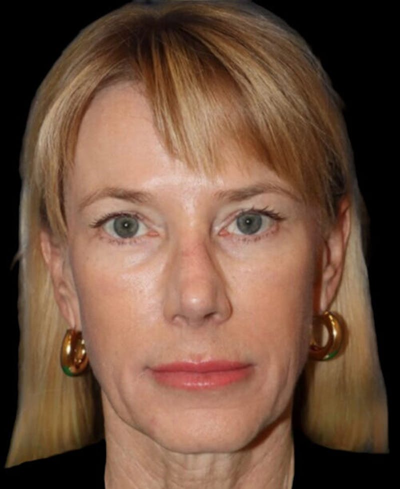 Facelift Before & After Gallery - Patient 508696 - Image 1