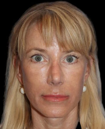 Facelift Before & After Gallery - Patient 508696 - Image 2