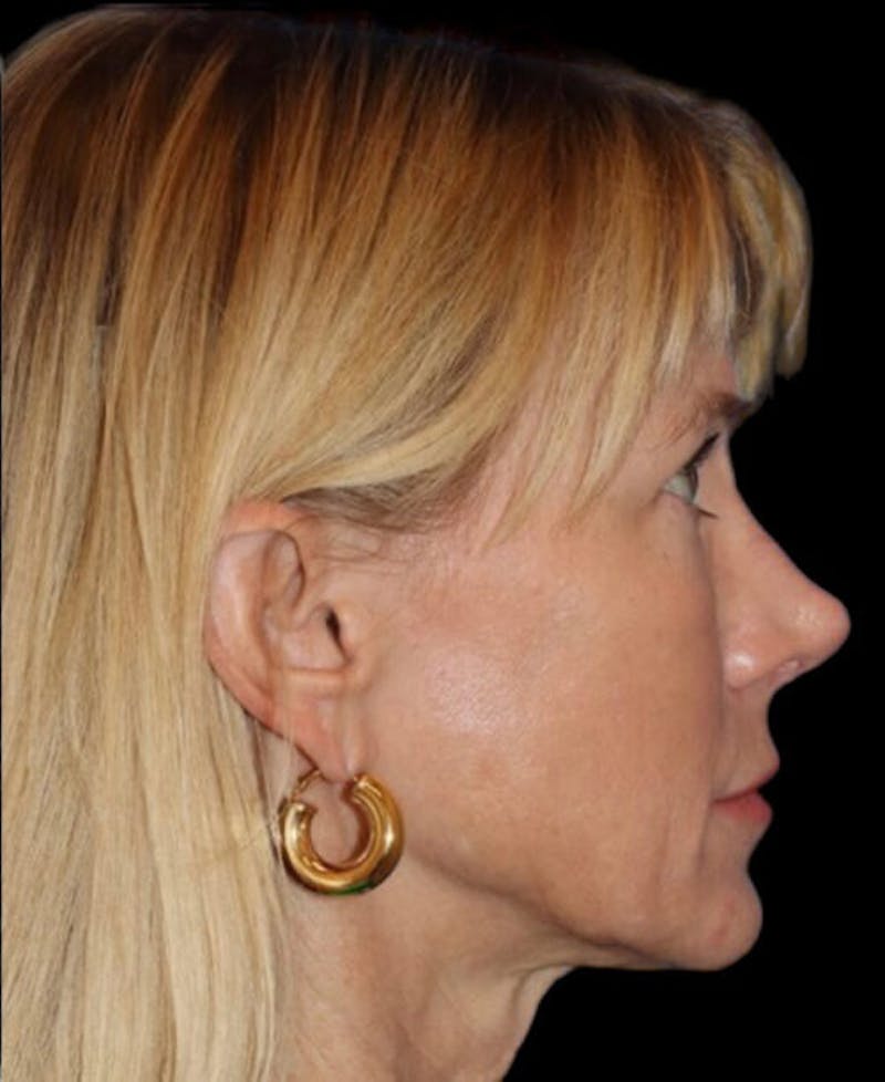 Facelift Before & After Gallery - Patient 508696 - Image 5