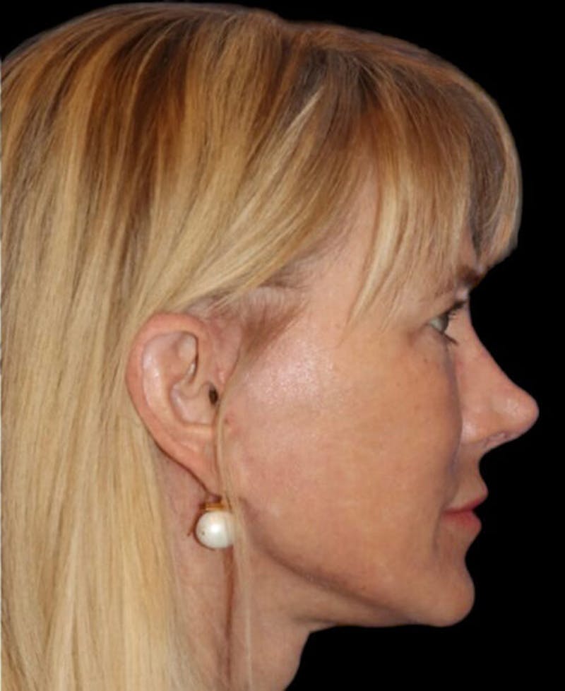 Facelift Before & After Gallery - Patient 508696 - Image 6