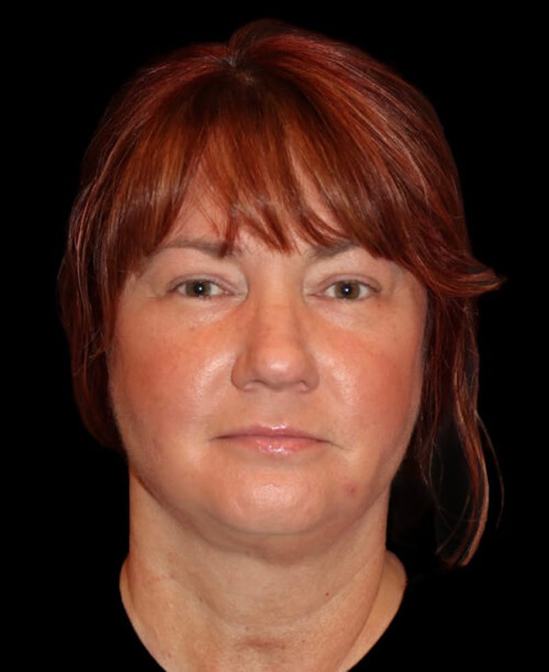 Facelift Before & After Gallery - Patient 595503 - Image 1