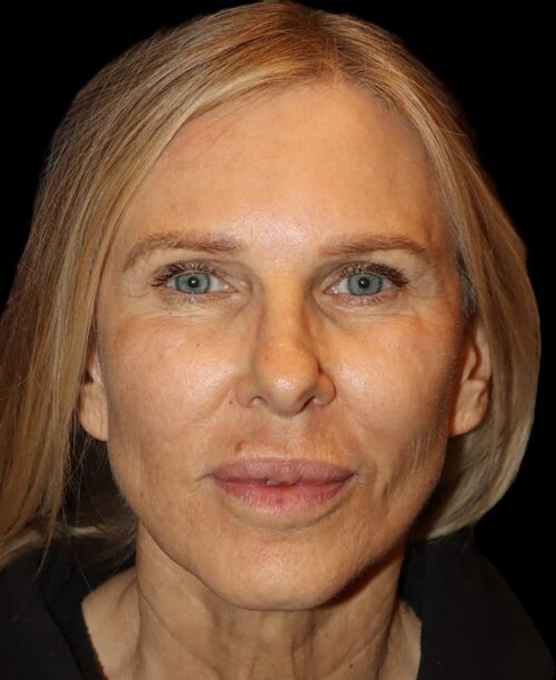 Laser Skin Resurfacing Before & After Gallery - Patient 718468 - Image 1