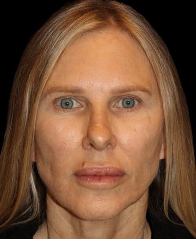 Laser Skin Resurfacing Before & After Gallery - Patient 718468 - Image 2