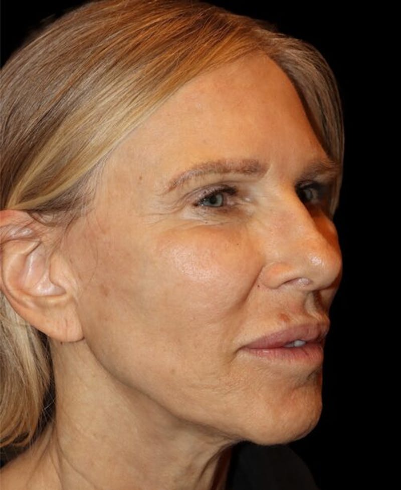 Laser Skin Resurfacing Before & After Gallery - Patient 718468 - Image 3