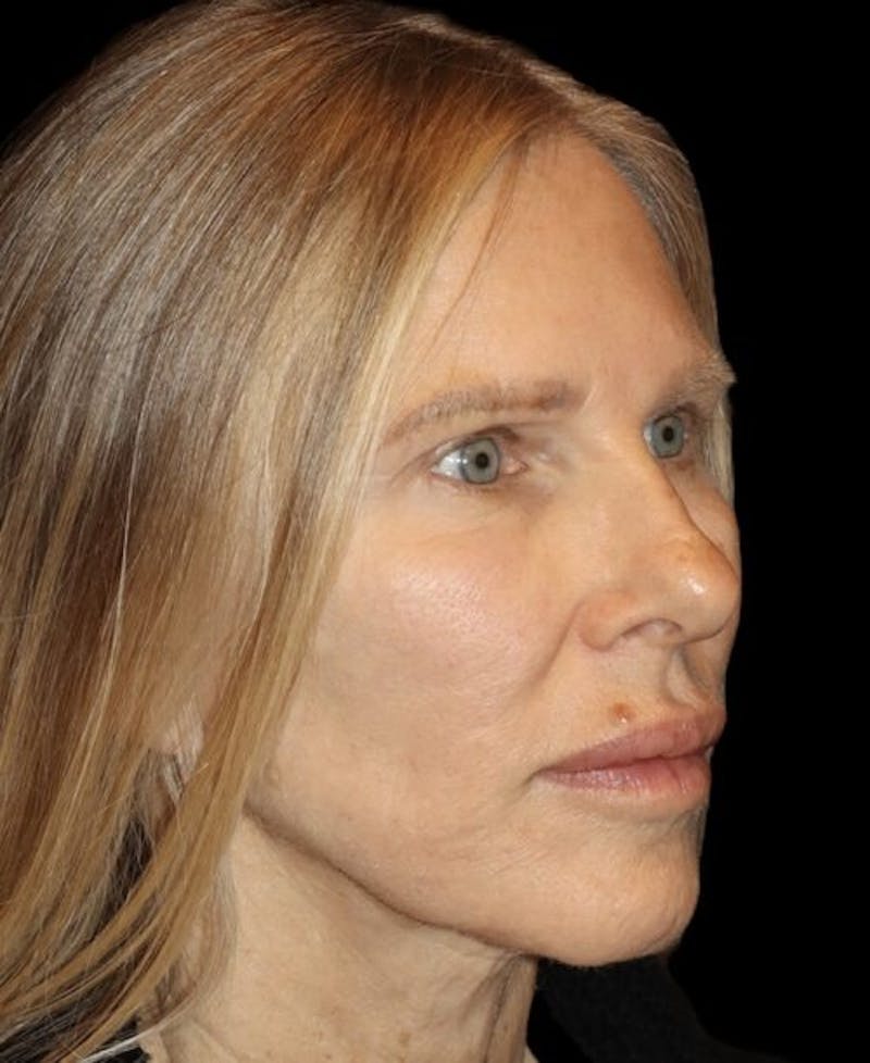 Laser Skin Resurfacing Before & After Gallery - Patient 718468 - Image 4