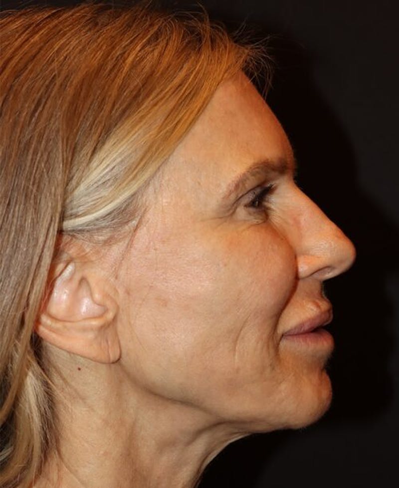 Laser Skin Resurfacing Before & After Gallery - Patient 718468 - Image 5