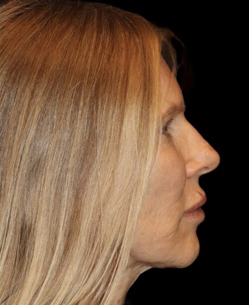 Laser Skin Resurfacing Before & After Gallery - Patient 718468 - Image 6