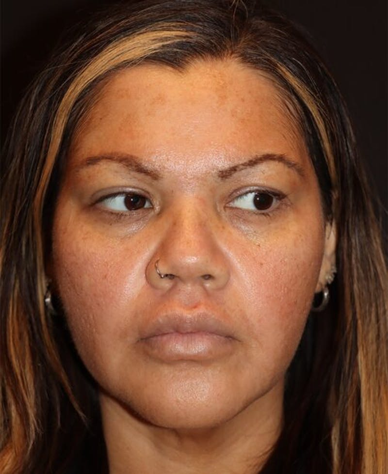 Laser Skin Resurfacing Before & After Gallery - Patient 282414 - Image 1