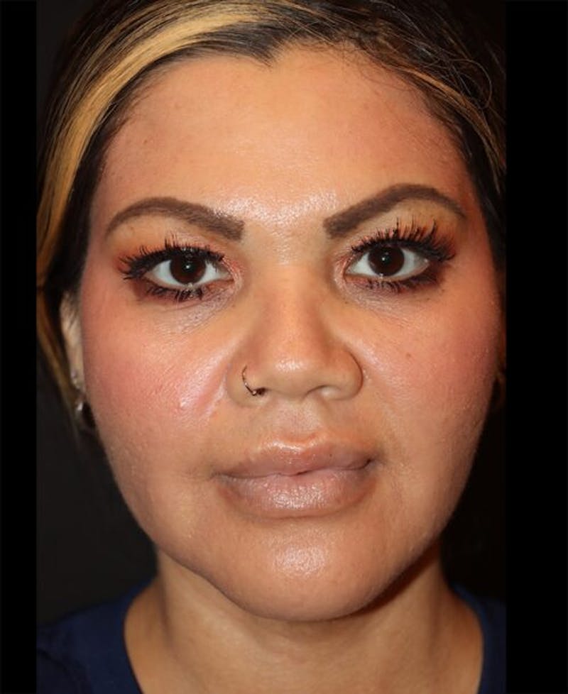 Laser Skin Resurfacing Before & After Gallery - Patient 282414 - Image 2