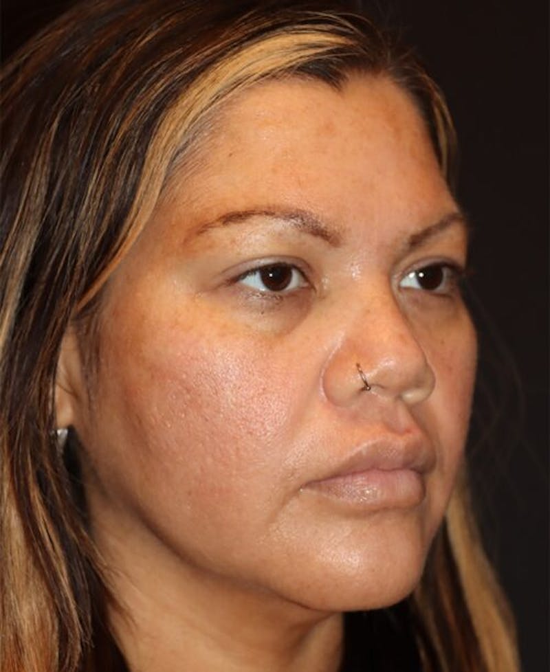 Laser Skin Resurfacing Before & After Gallery - Patient 282414 - Image 3