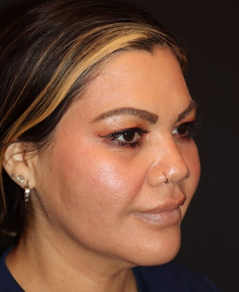 Laser Skin Resurfacing Before & After Gallery - Patient 282414 - Image 4