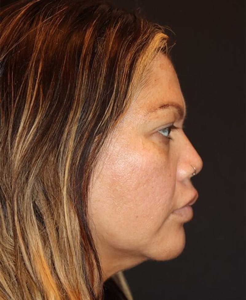 Laser Skin Resurfacing Before & After Gallery - Patient 282414 - Image 5