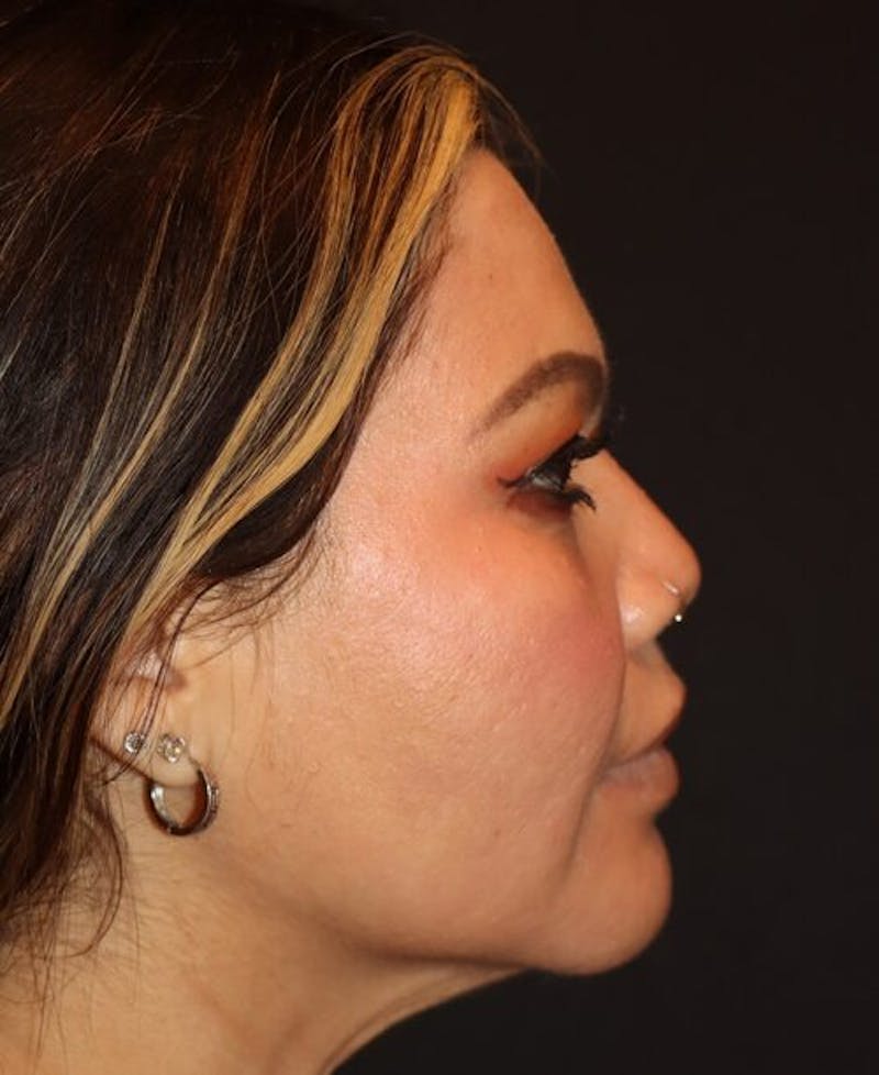 Laser Skin Resurfacing Before & After Gallery - Patient 282414 - Image 6