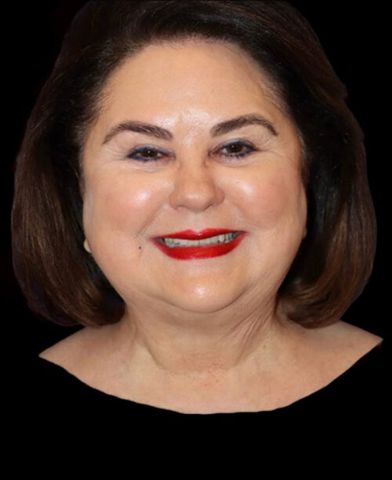 Neck Lift Before & After Gallery - Patient 248936 - Image 1